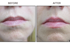 LB Fillers Lips - Patient17