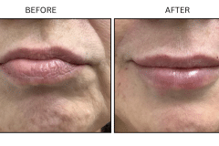 LB Fillers Lips - Patient18