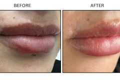 LB Fillers Lips - Patient2a