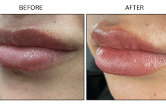 LB Fillers Lips - Patient2b