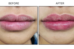 LB Fillers Lips - Patient3a