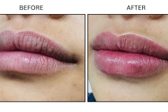 LB Fillers Lips - Patient3b