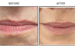 LB Fillers Lips - Patient4
