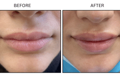 LB Fillers Lips - Patient5