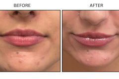 LB Fillers Lips - Patient6