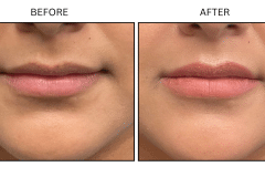 LB Fillers Lips - Patient7