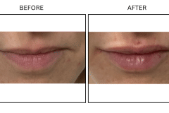 LB Fillers Lips - Patient8