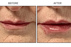 LB Fillers Lips - Patient9