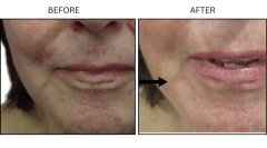 LB Fillers Marionette Lines - Patient1