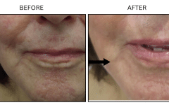 LB Fillers Marionette Lines - Patient1