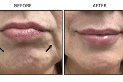 LB Fillers Marionette Lines - Patient2
