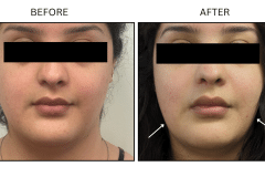 LB Neurotx Relx Masseter - Patient2