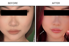 LB Neurotx Relx Masseter - Patient3