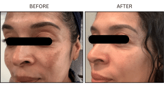 LB Medical Melasma - Patient1b