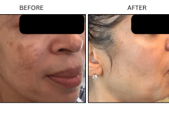 LB Medical Melasma - Patient1a