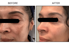 LB Medical Melasma - Patient1b