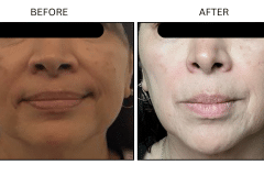 LB Medical Melasma - Patient2