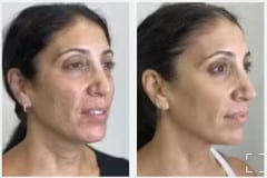 02Micro-Needling