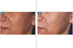 03Micro-Needling