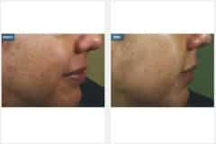 04Micro-Needling