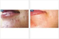 05Micro-Needling