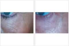 07Micro-Needling