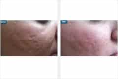 08Micro-Needling