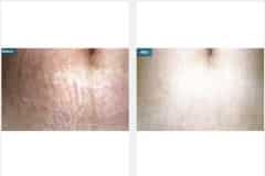 10Micro-Needling
