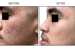 Microneedling Acne Scars - Patient1