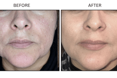 Microneedling Acne Scars - Patient2