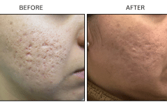 Microneedling Acne Scars - Patient3a