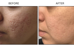 Microneedling Acne Scars - Patient3b