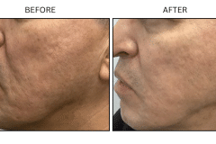 Microneedling Acne Scars - Patient4a