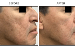 Microneedling Acne Scars - Patient4b