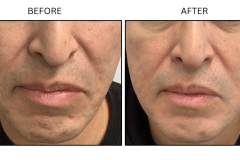 Microneedling Acne Scars - Patient4c