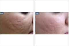 11Micro-Needling