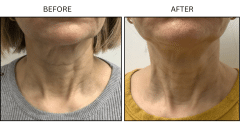 LB Lasers Morpheus8 - Patient2b