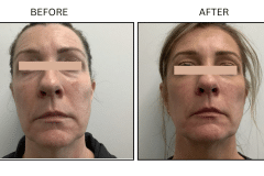 LB Lasers Morpheus8 - Patient19a