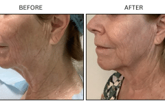 LB Lasers Morpheus8 - Patient20a