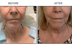 LB Lasers Morpheus8 - Patient20b