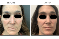 LB Lasers Morpheus8 - Patient22