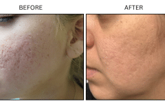 LB Lasers Morpheus8 - Patient1a
