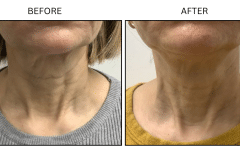 LB Lasers Morpheus8 - Patient2b