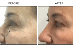 LB Lasers Morpheus8 - Patient5