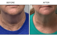 LB Lasers Morpheus8 - Patient8