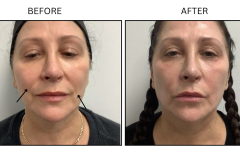 LB Lasers Morpheus8 - Patient14b