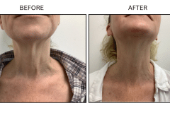 LB Lasers Morpheus8 - Patient17a