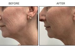 LB Lasers Morpheus8 - Patient17b