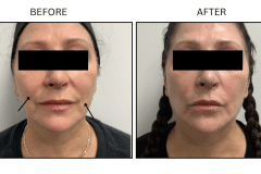 LB Lasers Morpheus8 - Patient14b