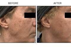 LB Lasers Morpheus8 - Patient16